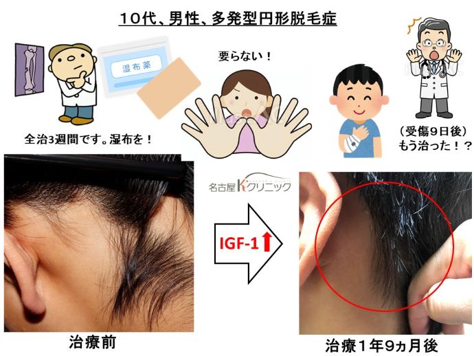 円形脱毛症　病院